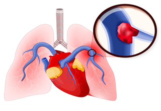 Rapid multi-disciplinary care for patients with Pulmonary Embolism